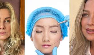 Nem silicone, nem lipo HD: Brasil é TOP1 do ranking mundial de cirurgia plástica feita por Luana Piovani, Letícia Spiller e mais famosas.