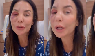O que aconteceu com Ivete Sangalo? Cantora quebra dois ossos do rosto após desmaio, passa por cirurgia e surge inchada nas redes: ‘Estou bem’.