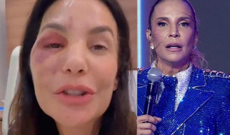 'Ela precisa se recuperar': após fratura no rosto e cirurgia recente, Ivete Sangalo é confirmada no Big Brother Brasil 26 e preocupa fãs.