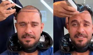 Diogo Nogueira traz à tona como o implante capilar utiliza fios do próprio paciente.