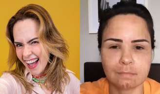 Ana Paula Renault surge irreconhecível e inchada em vídeo antigo após procedimento estético; antes e depois viraliza: 'Pelo visto funcionou'.