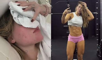 Treinar pode causar crises de enxaqueca? Médico tira dúvidas após Virgínia revelar mudanças em exercícios devido ao diagnóstico: ‘Priorizar regularidade em vez de intensidade’.