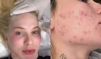 Virginia Fonseca resgatou uma foto de 2023 e mostrou como a pele ficou afetada após o uso de hormônios.