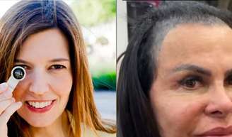 Gretchen sofre com a queda de cabelo.