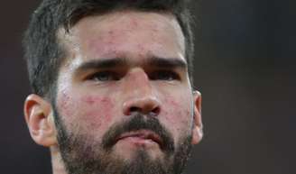 O que é a vermelhidão no rosto de Alisson Becker, o goleiro do Brasil na Copa 2026? Doença crônica não tem cura, aponta médica especialista - na foto, jogador durante a Copa 2018.