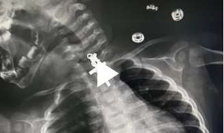 Raio-X mostra crucifico preso em garganta de bebê