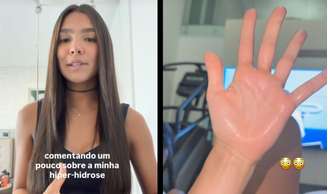 A influenciadora Duda Guerra fala sobre hiperidrose