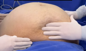 Médico retira cisto de quase 8 kg de paciente em hospital: ‘Foi um dos maiores que já removi’
