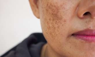 Melasma: máscara facial reduz as manchas escuras