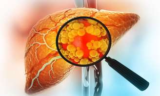 Esteatose hepática: 30% da população brasileira tem gordura no fígado -