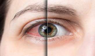 Sintomas da síndrome do olho seco pioram em julho; veja como prevenir -