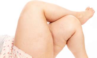 Lipedema ou celulite? Especialista explica as diferenças entre as condições