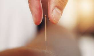 Saúde física e mental: veja o que a acupuntura pode tratar