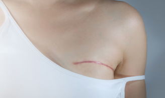 Procedimento é realizado após a mastectomia (remoção total ou parcial da mama) para restaurar a forma e a aparência do seio