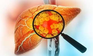 Esteatose hepática: 30% da população brasileira tem gordura no fígado