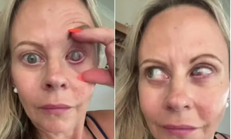 Emma Marsden, que usa lentes de contato, caiu de cabeça em um carrinho de mão cheio de terra e água e teve perda de visão