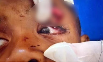 Menino de 6 anos atingido em tiroteio no RJ perde a visão do olho esquerdo