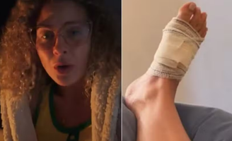 Debby Lagranha passa por cirurgia após sofrer picada de aranha-marrom: 'Muita dor'