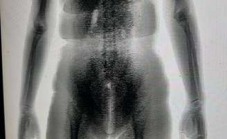 A imagem do BodyScan mostrou um volume estranho no corpo da mulher