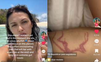 Influencer é picada por água-viva venenosa enquanto gravava vídeo nas Filipinas