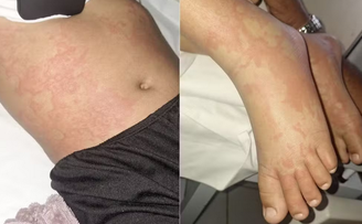 Família acredita que menina teve reação alérgica por estar com um corte na mão quando usou o detergente