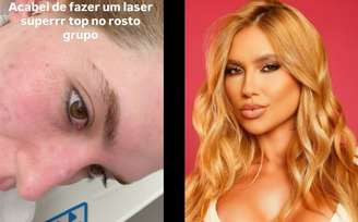 Virginia faz tratamento para tirar marcas de acne