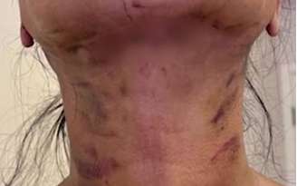Pacientes tiveram lesão grave após realizar lipoaspiração de papada e lifting facial, procedimentos cirúrgicos que removem o excesso de pele e gordura da região do pescoço