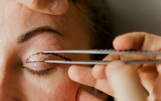 Blefaroplastia