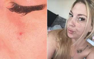 Ferida que não cicatriza