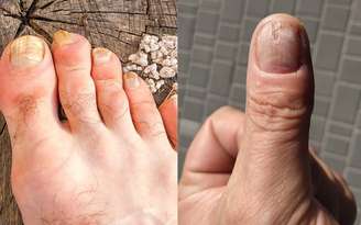 Como tratar a onicomicose / Canva