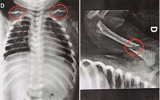 Radiografia de bebê de cerca de 50 dias mostram as fraturas; pai foi preso por maus-tratos.