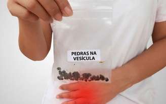 Quais os sintomas de pedra na vesícula? / Canva