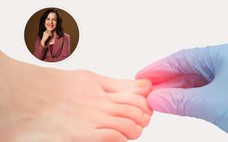 Micose nas unhas / Canva