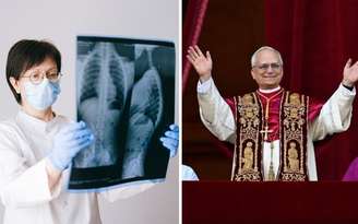 O nódulo pulmonar pode ter diferentes causas e nem sempre indica câncer. Entenda o que se sabe sobre o caso do papa Leão XIV. Imagem ilustrativa: Canva. Foto do papa: reprodução.