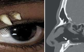 À esquerda, o canino encontrado na órbita ocular de um adolescente de 16 anos, na Índia. À direita, o dente identificado na cavidade nasal de um homem de 38 anos. Créditos: Ophthalmology / AAO Journal e New England Journal of Medicine (NEJM).