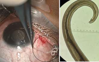 Verme adulto macho da espécie Loa loa extraído do olho da paciente (à esquerda) e registro microscópico de laboratório utilizado na identificação do parasita (à direita).