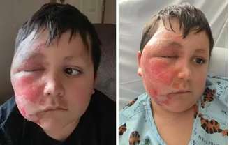 Menino teve queimaduras de segundo grau