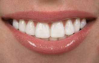 Um dos recursos para garantir dentes alinhados e branquinhos em apenas algumas horas é a faceta de porcelana