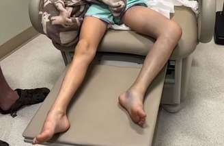 Garotinha de 7 anos passou cerca de 30 horas com veneno de cobra na perna