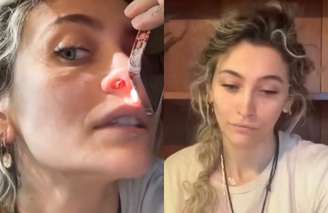 Paris Jackson mostra sequela do uso de drogas