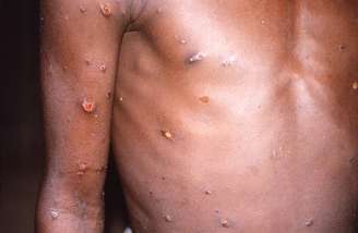 Varíola dos macacos é uma doença que provoca febre e erupções cutâneas