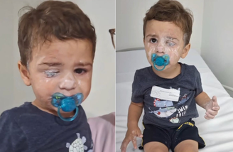 Bebê vai parar no hospital após passar Super Bonder no rosto e grudar o olho em SC