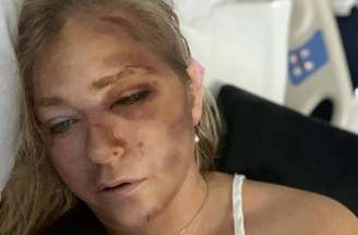 Virginia Giuffre em foto publicada nas redes sociais após o acidente