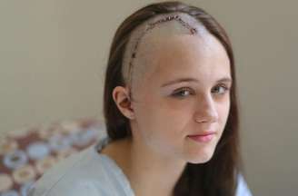 <p>Sophia Putney-Wilcox foi atingida por um taco de beisebol usado pelo irmão para tentar intimidar o agressor</p>