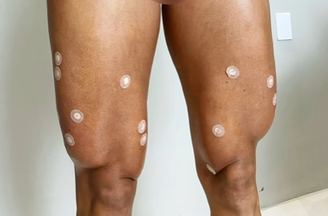 Entenda o que é a harmonização do quadríceps 