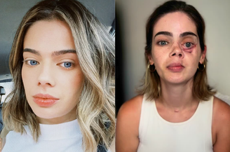 Ana Luiza Prestes, cirurgiã-dentista de 29 anos, passou por cirurgia para a retirada do tumor