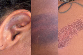 Advogada Edricélia Silva denunciar ter sido agredida por PMs na madrugada do último domingo, 30, durante a Festa do Caju, em Serra do Mel