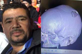 Ivan Bezerra da Silva teve traumatismo cranioencefálico