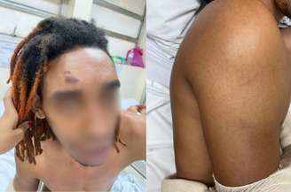 Wellington Valério teve o ombro quebrado e a testa durante a confusão