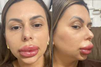 Sandra Mara Antônio teve uma reação alérgica ao fazer o retoque do preenchimento labial